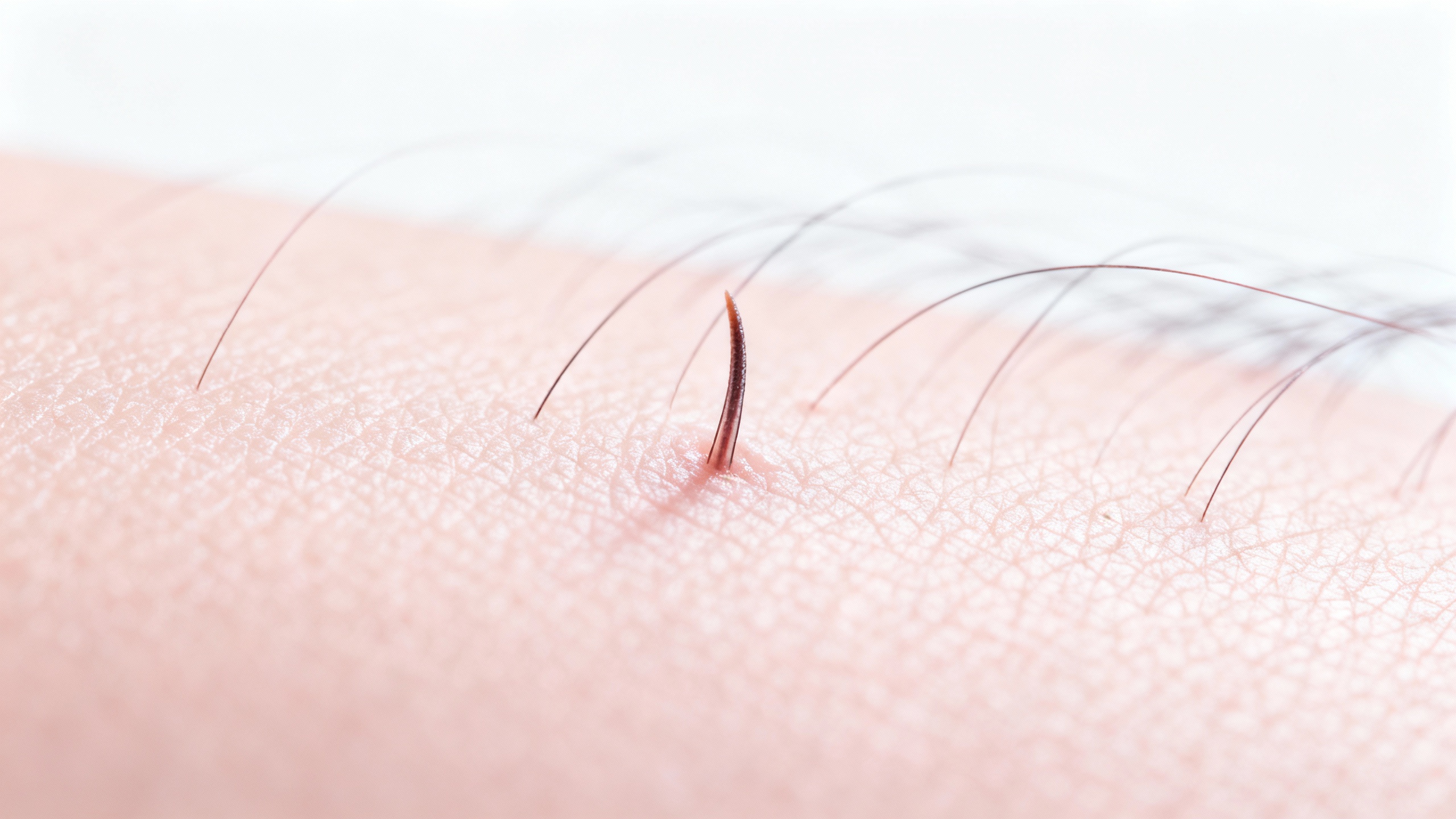 Featured image for Why do I get acne on my scalp?